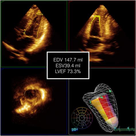 3d volumetric lv volumed|3d echocardiogram lv volume.